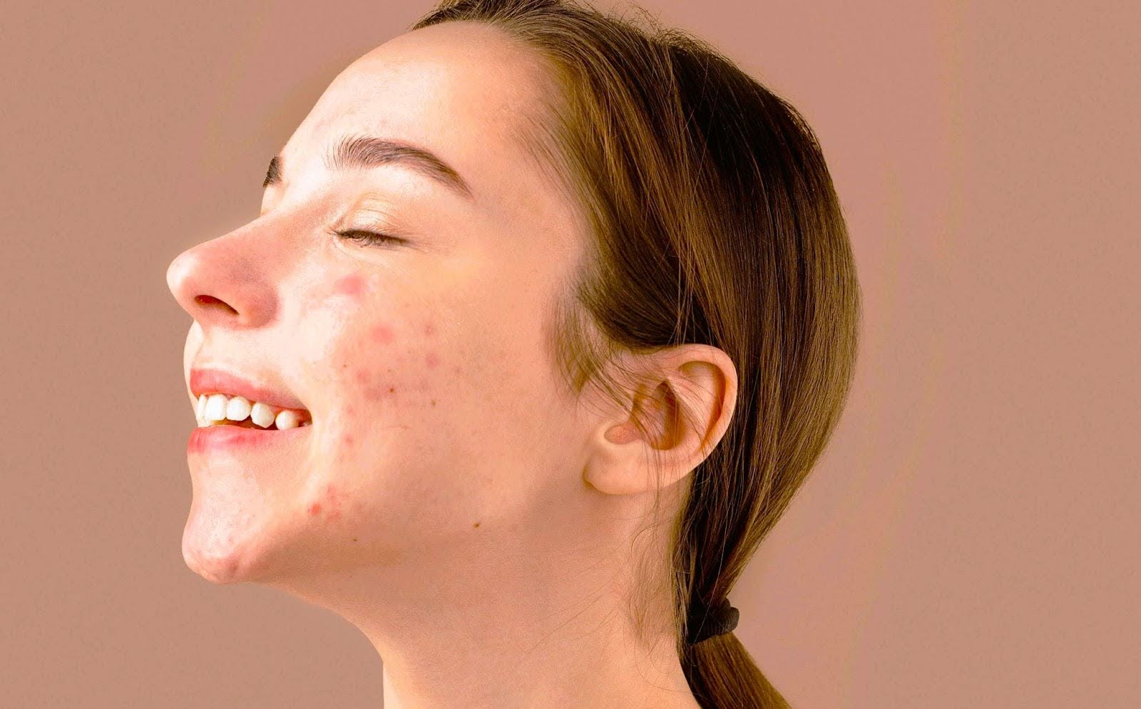 Infrared sauna skin benefits for woman with acne