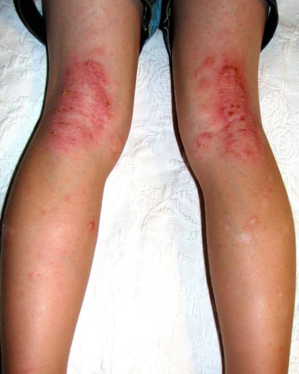 Relieving Winter Eczema Flare-Ups Effectively With Infrared Saunas ...